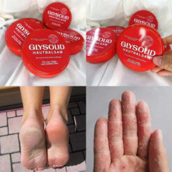 Kem chống nẻ Glysolid trị nứt nẻ da, nứt gót chân
